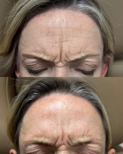 Botox Before & After Gallery - Patient 143823 - Image 1