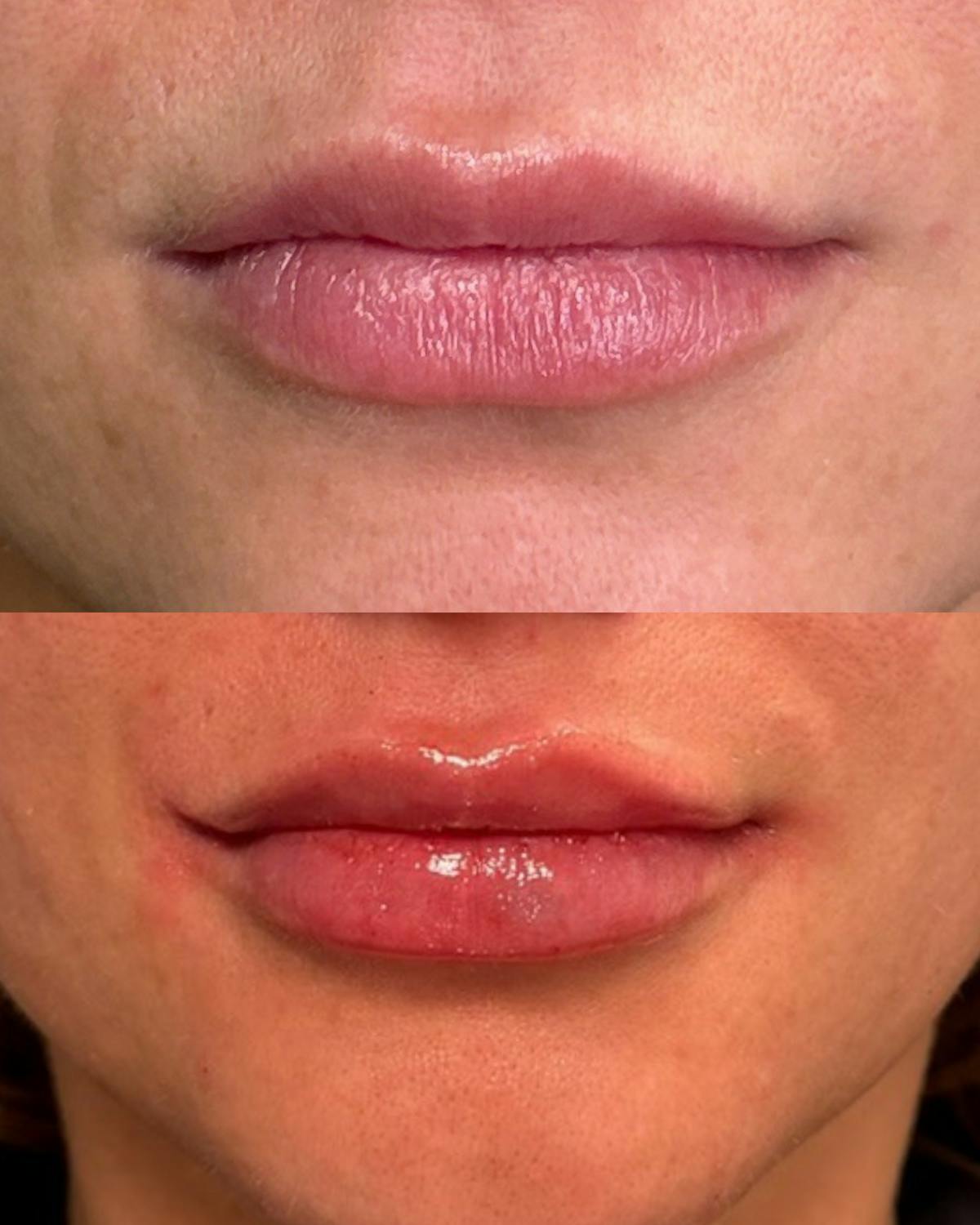 Lip Filler  Before & After Gallery - Patient 335671 - Image 1