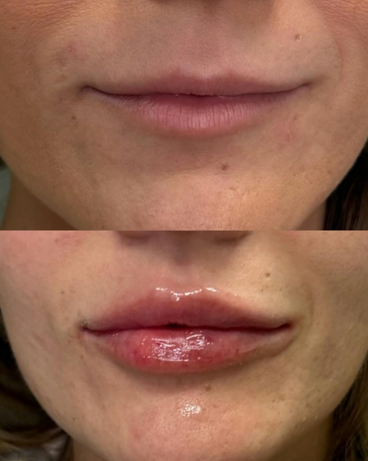 Lip Filler  Before & After Gallery - Patient 536196 - Image 1
