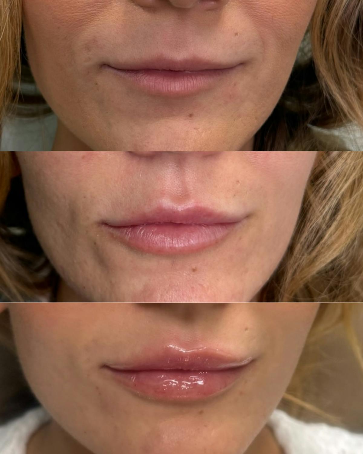 Lip Filler  Before & After Gallery - Patient 536196 - Image 2