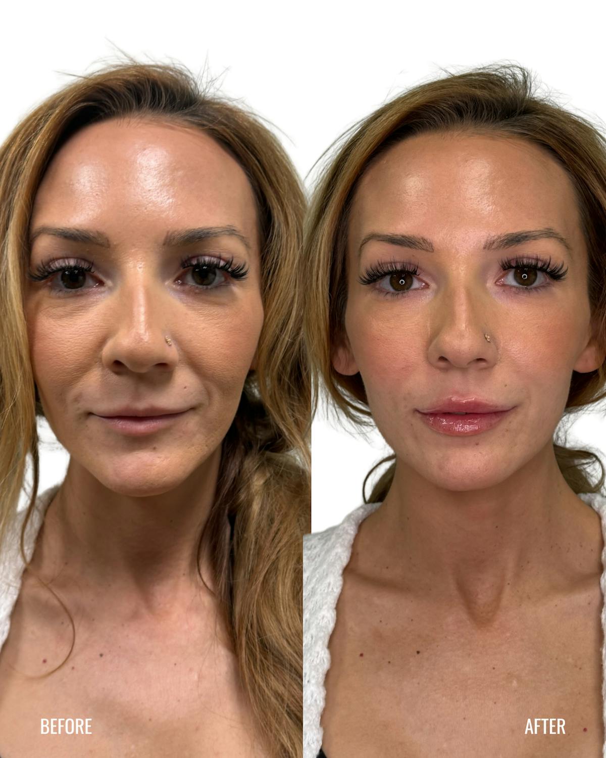 Lip Filler  Before & After Gallery - Patient 536196 - Image 3