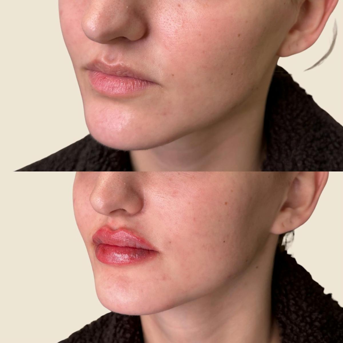 Lip Filler  Before & After Gallery - Patient 202763 - Image 2