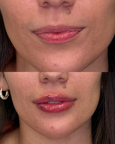 Lip Filler  Before & After Gallery - Patient 202118 - Image 1