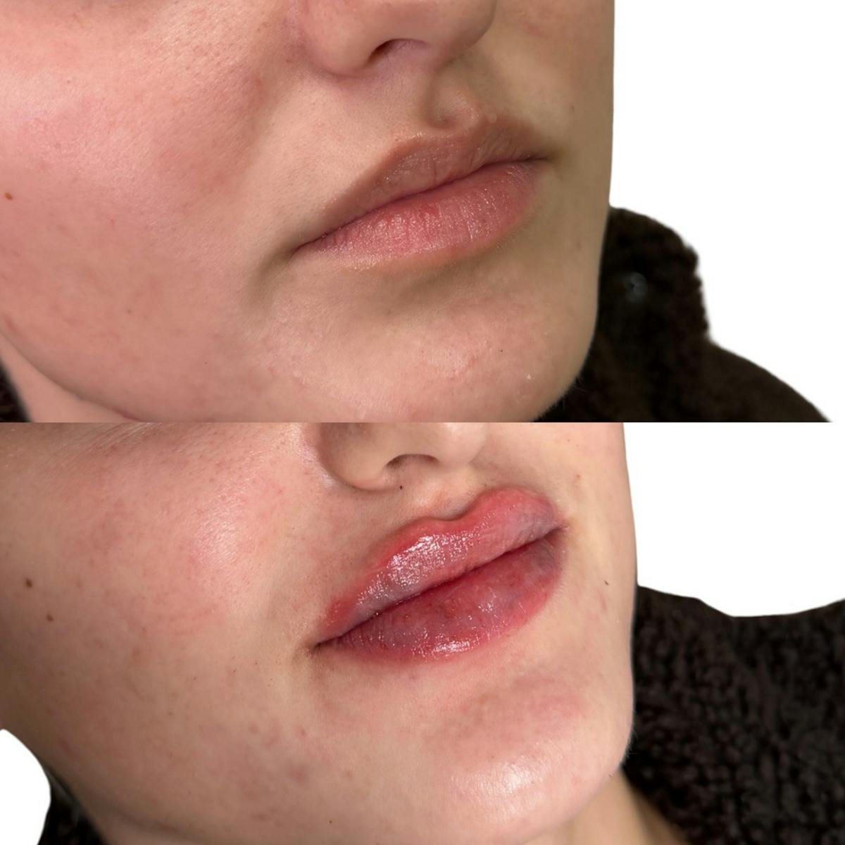 Lip Filler  Before & After Gallery - Patient 202763 - Image 1