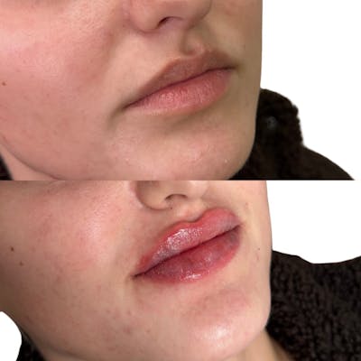 Lip Filler  Before & After Gallery - Patient 202763 - Image 1