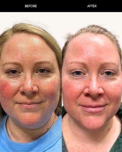 Laser Treatment (IPL) Before & After Gallery - Patient 412233 - Image 1