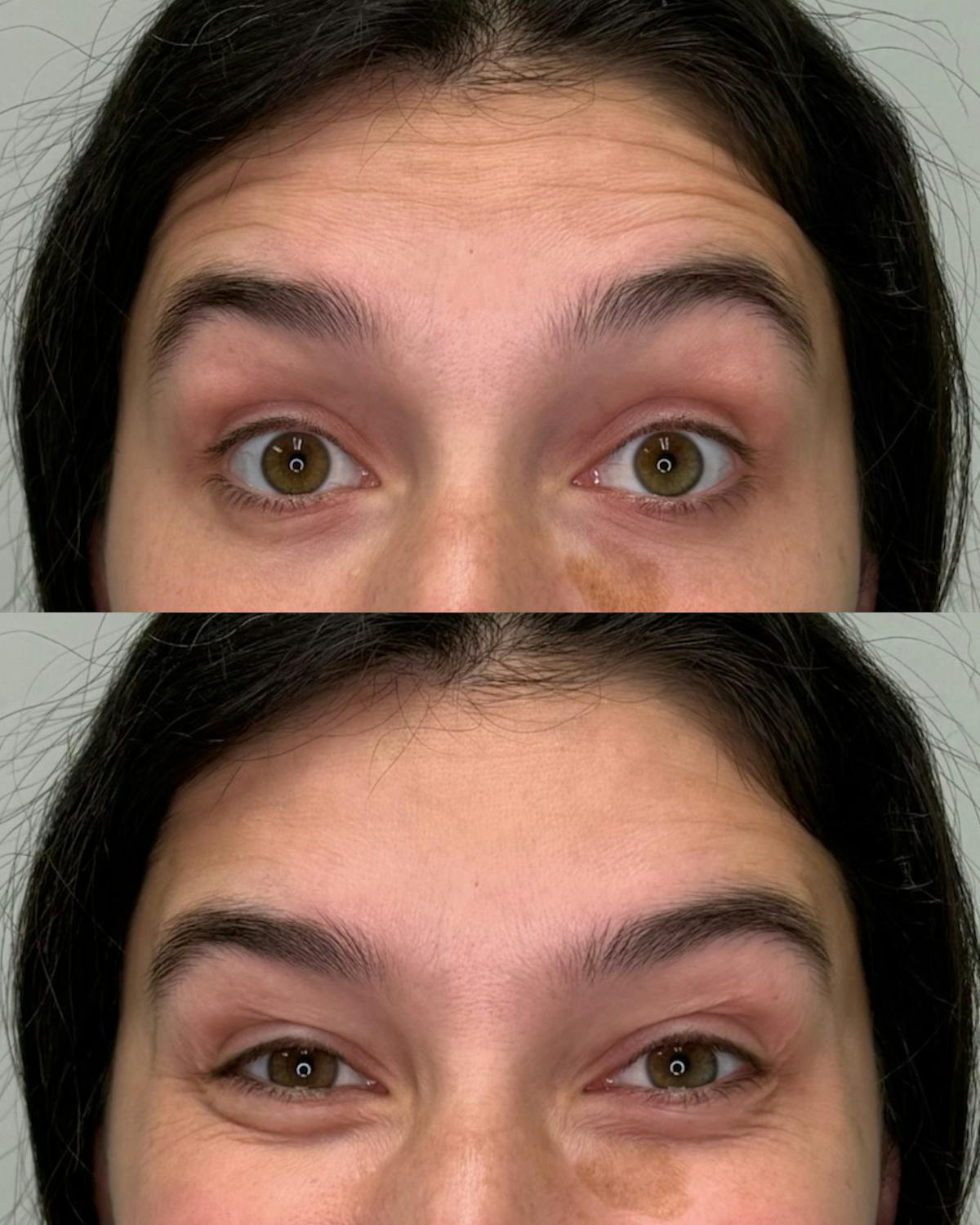 Botox Before & After Gallery - Patient 489816 - Image 1