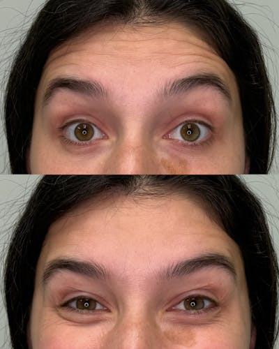 Botox Before & After Gallery - Patient 489816 - Image 1