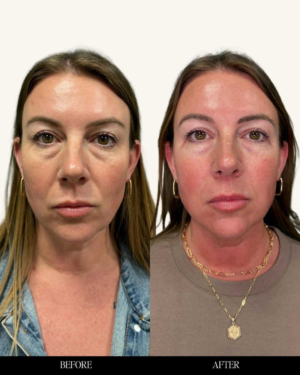 Micronjet Before & After Gallery - Patient 457018 - Image 2