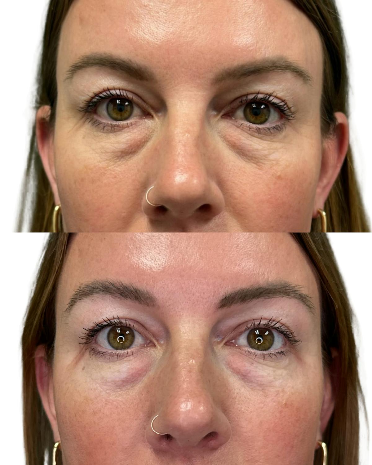 Micronjet Before & After Gallery - Patient 457018 - Image 1