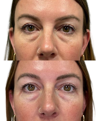 Micronjet Before & After Gallery - Patient 457018 - Image 1