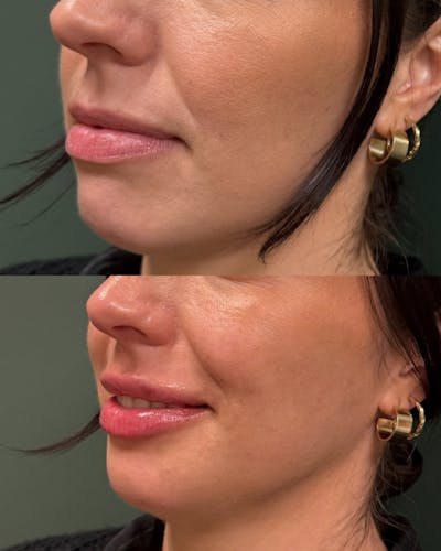 Lip Filler  Before & After Gallery - Patient 255655 - Image 1