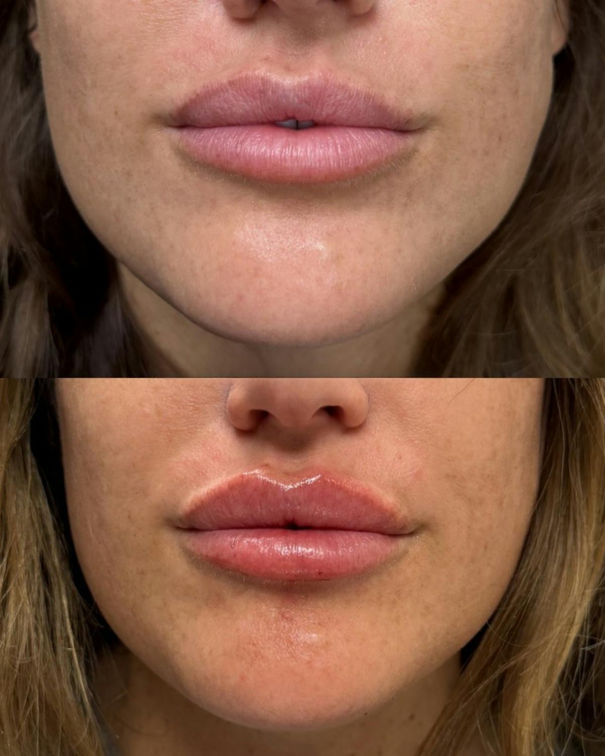 Lip Filler  Before & After Gallery - Patient 130177 - Image 1