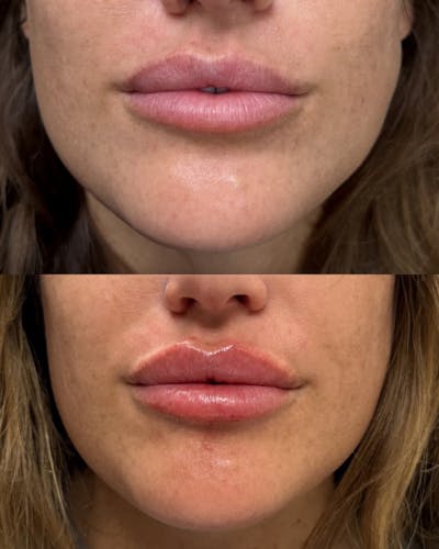 Lip Filler  Before & After Gallery - Patient 130177 - Image 1