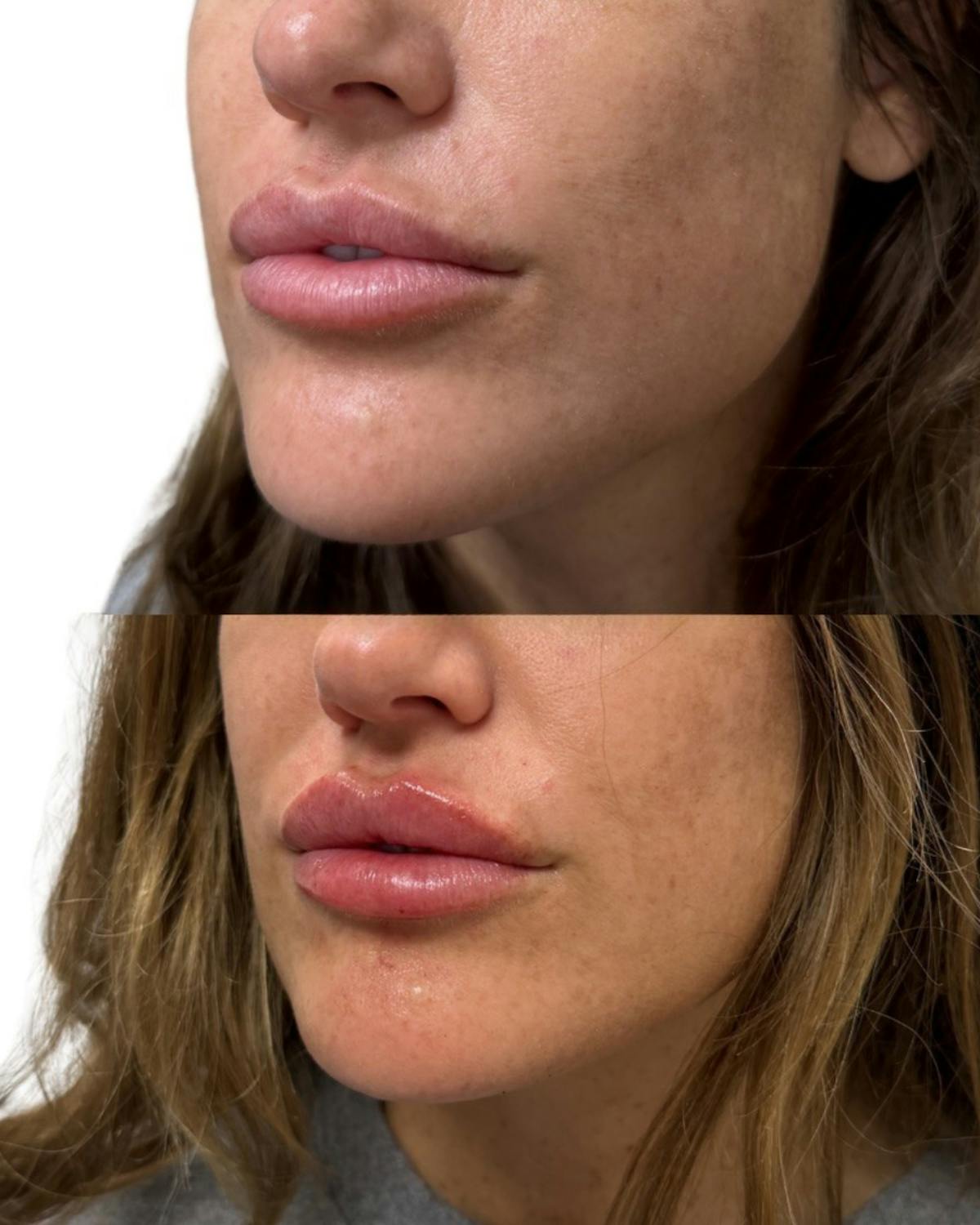Lip Filler  Before & After Gallery - Patient 130177 - Image 2