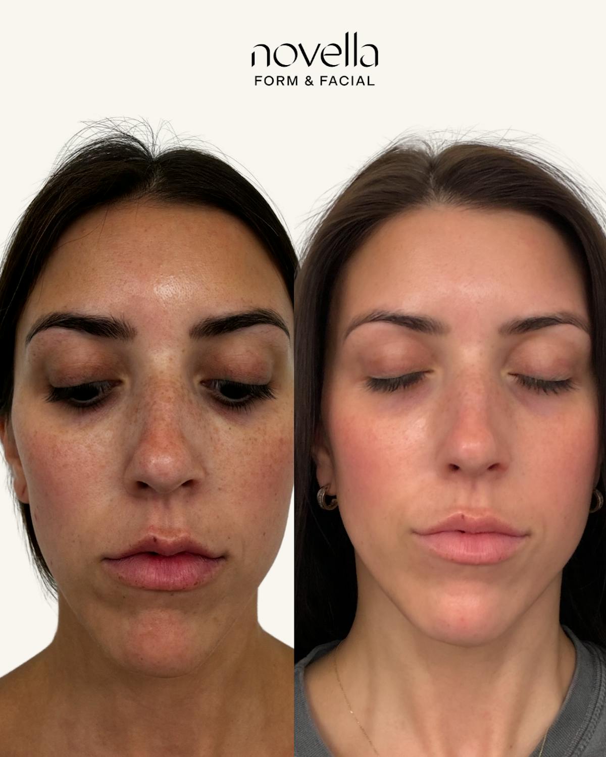Skincare Before & After Gallery - Patient 169540 - Image 1