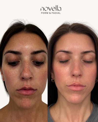 Skincare Before & After Gallery - Patient 169540 - Image 1