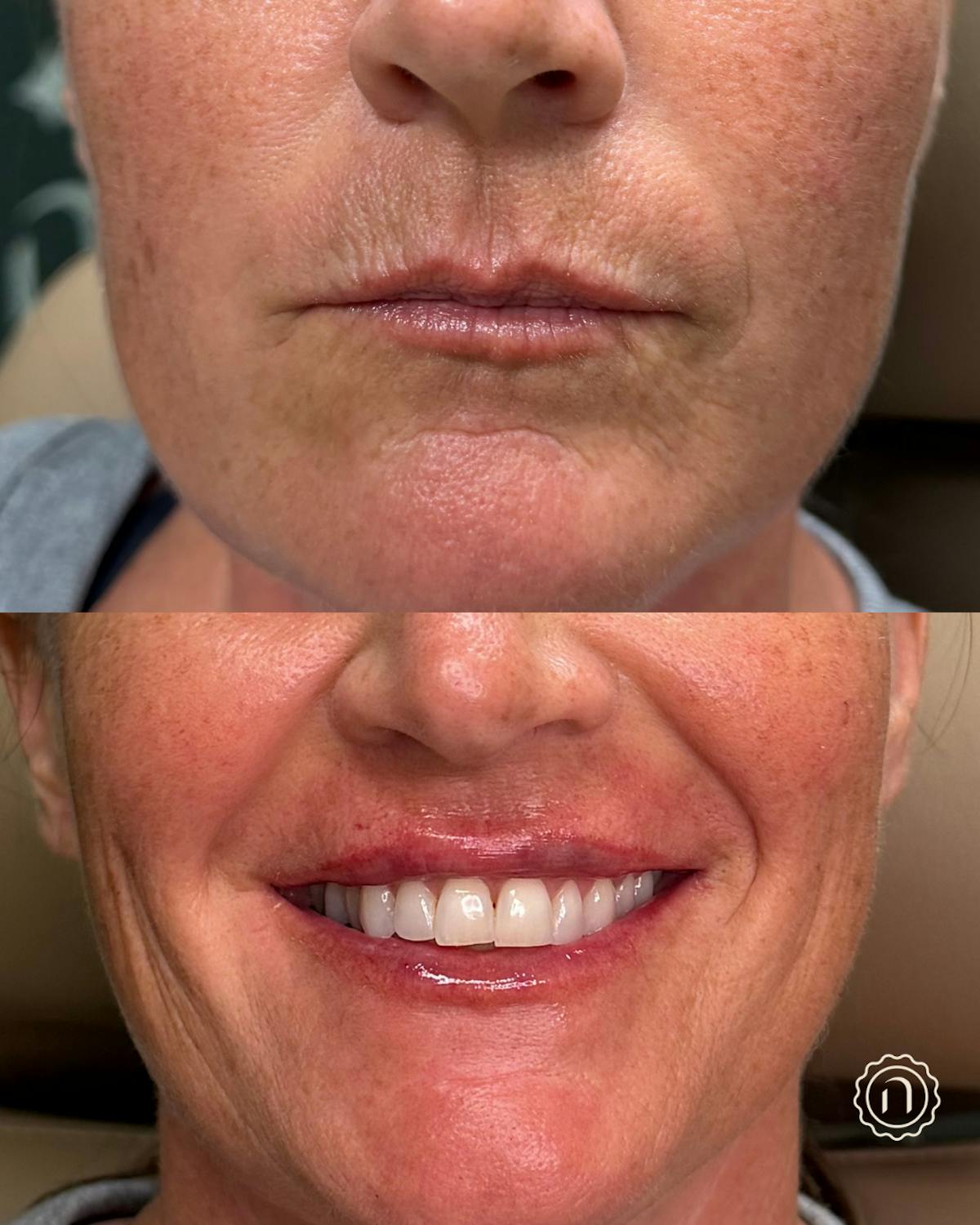 Lip Filler  Before & After Gallery - Patient 898086 - Image 1