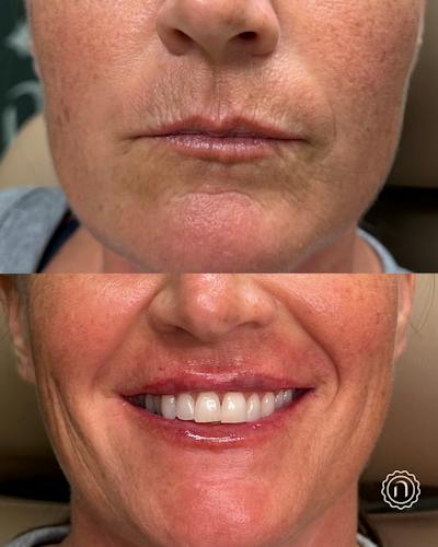 Lip Filler  Before & After Gallery - Patient 898086 - Image 1