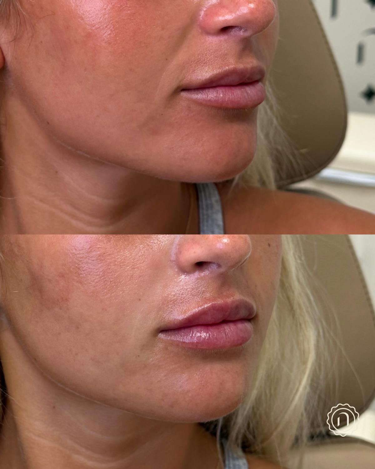 Lip Filler  Before & After Gallery - Patient 162168 - Image 2