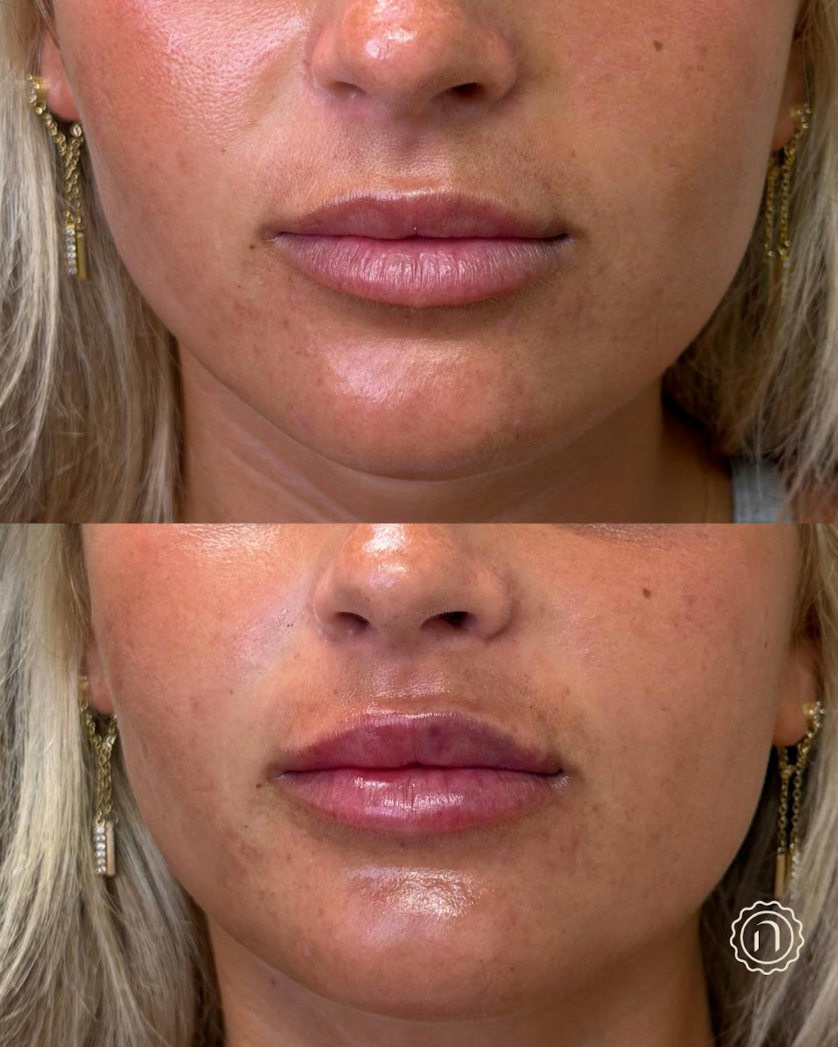 Lip Filler  Before & After Gallery - Patient 162168 - Image 1