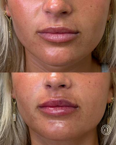 Lip Filler  Before & After Gallery - Patient 162168 - Image 1
