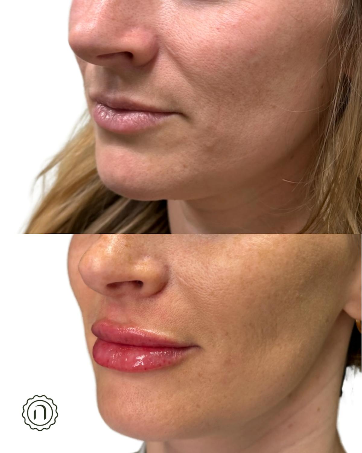 Lip Filler  Before & After Gallery - Patient 225810 - Image 2