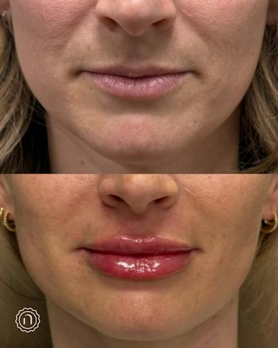 Lip Filler  Before & After Gallery - Patient 225810 - Image 1