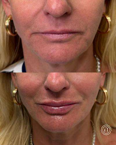 Lip Filler  Before & After Gallery - Patient 659154 - Image 1