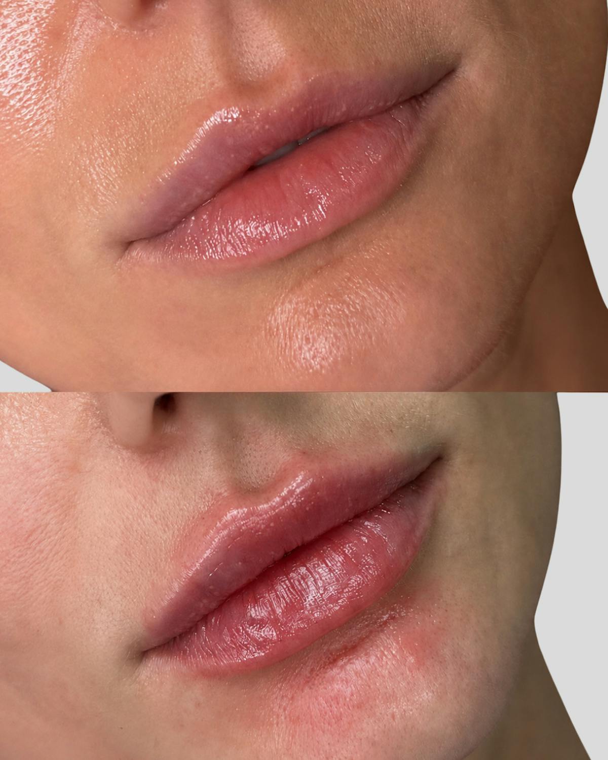 Lip Filler  Before & After Gallery - Patient 514217 - Image 2