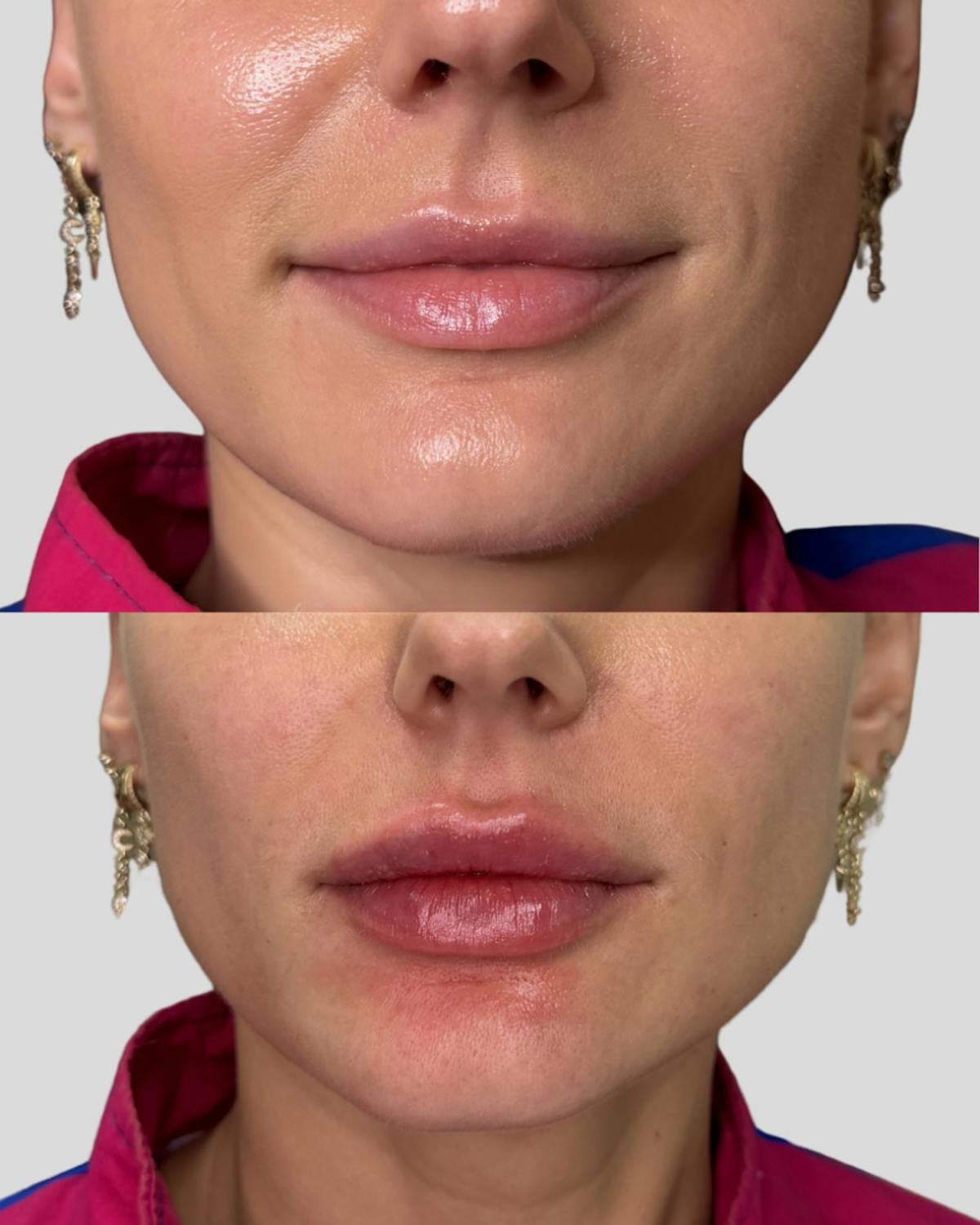Lip Filler  Before & After Gallery - Patient 514217 - Image 4
