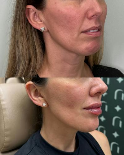 Lip Filler  Before & After Gallery - Patient 355146 - Image 1