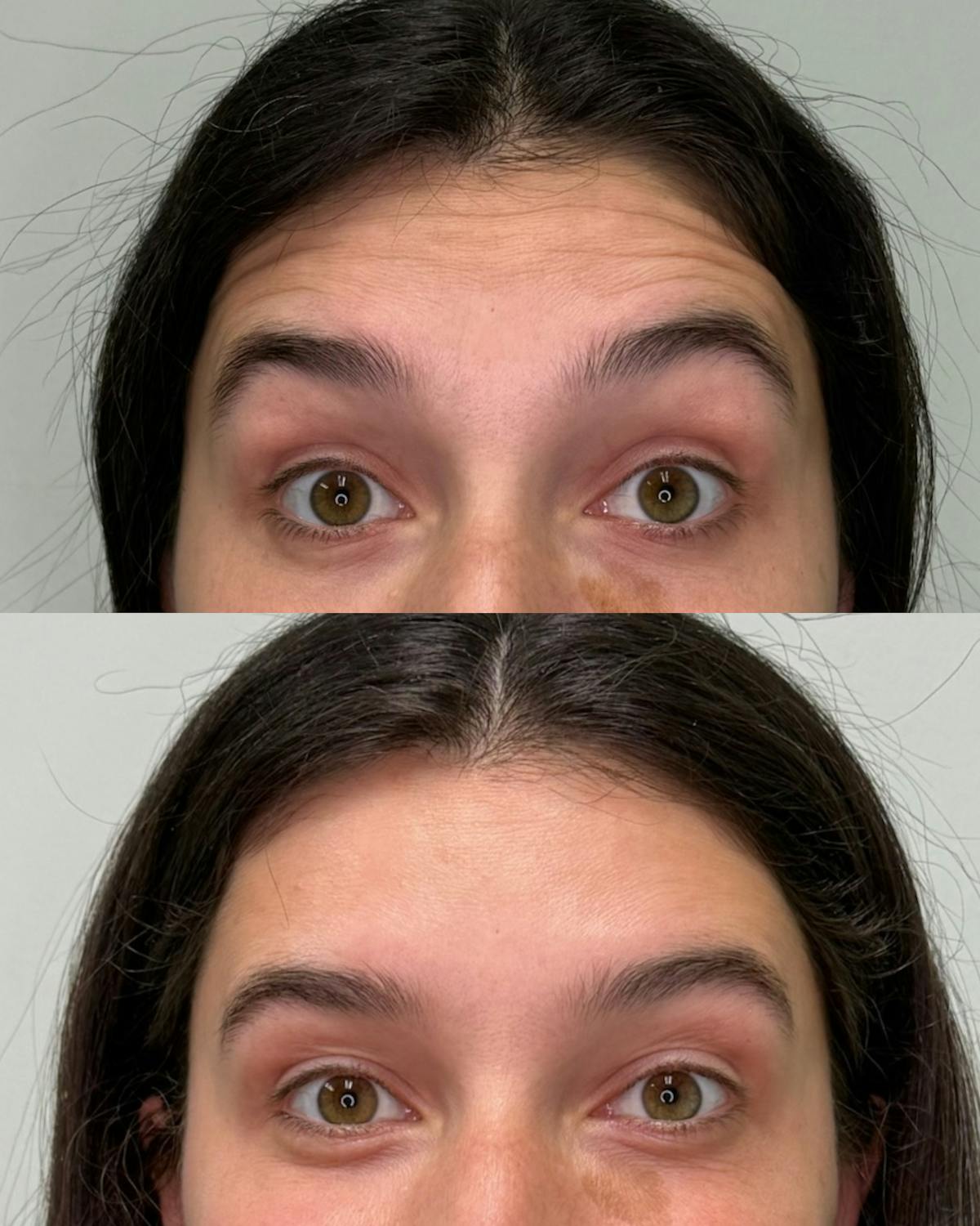 Botox Before & After Gallery - Patient 158357 - Image 1