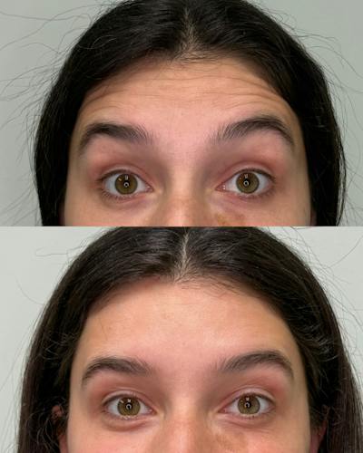 Botox Before & After Gallery - Patient 158357 - Image 1