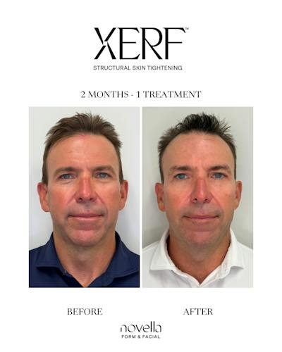 XERF Before & After Gallery - Patient 406075 - Image 1