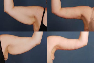 Arm Lift Before & After Gallery - Patient 203525 - Image 1