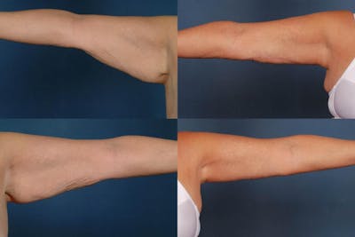 Arm Lift Before & After Gallery - Patient 370736 - Image 1