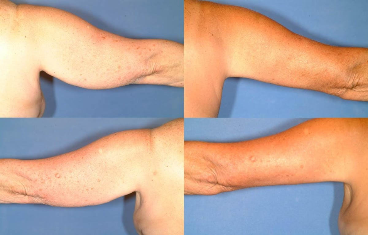 Arm Lift Before & After Gallery - Patient 177419 - Image 2