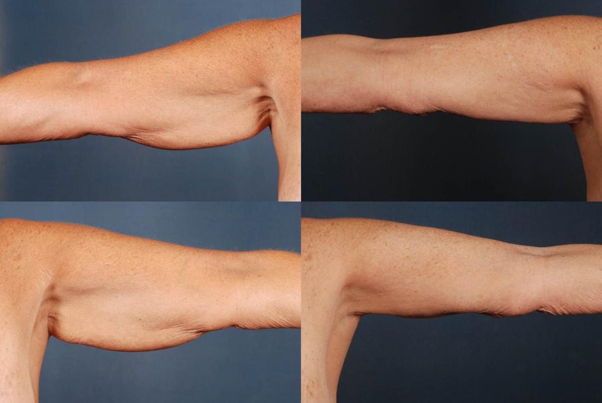 Arm Lift Before & After Gallery - Patient 130628 - Image 1