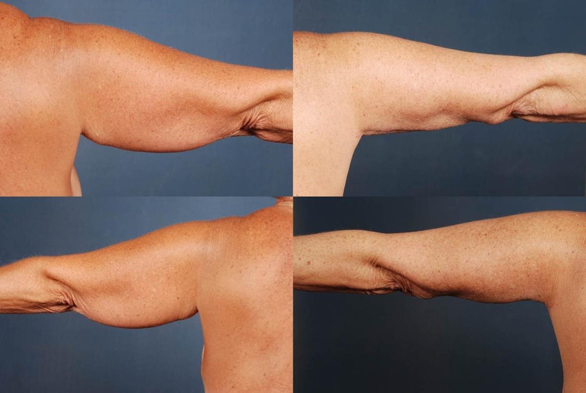 Arm Lift Before & After Gallery - Patient 130628 - Image 2