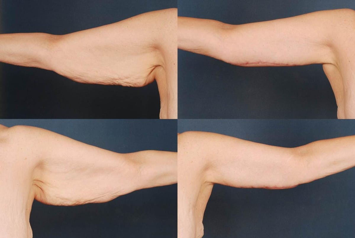 Arm Lift Before & After Gallery - Patient 801360 - Image 1