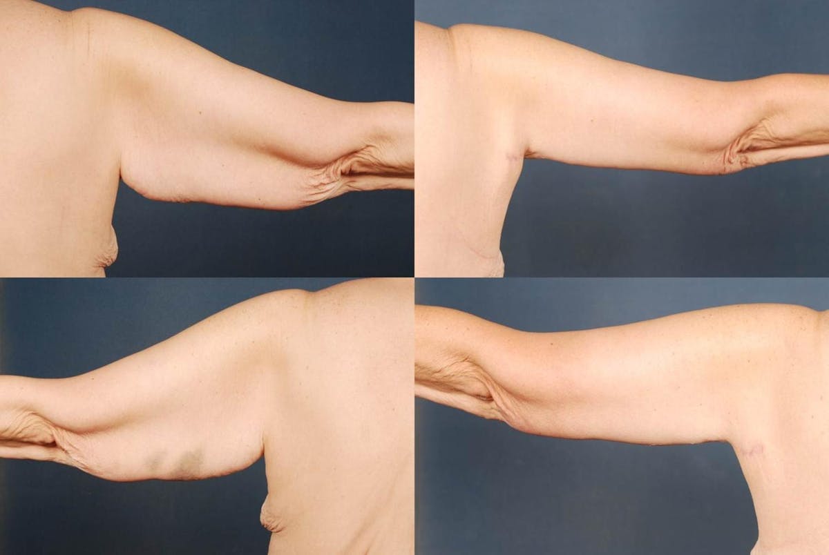 Arm Lift Before & After Gallery - Patient 801360 - Image 2