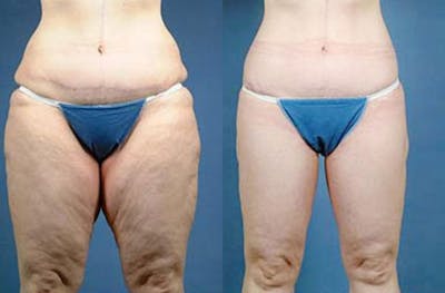 Body/Thigh Lift Before & After Gallery - Patient 165054 - Image 1