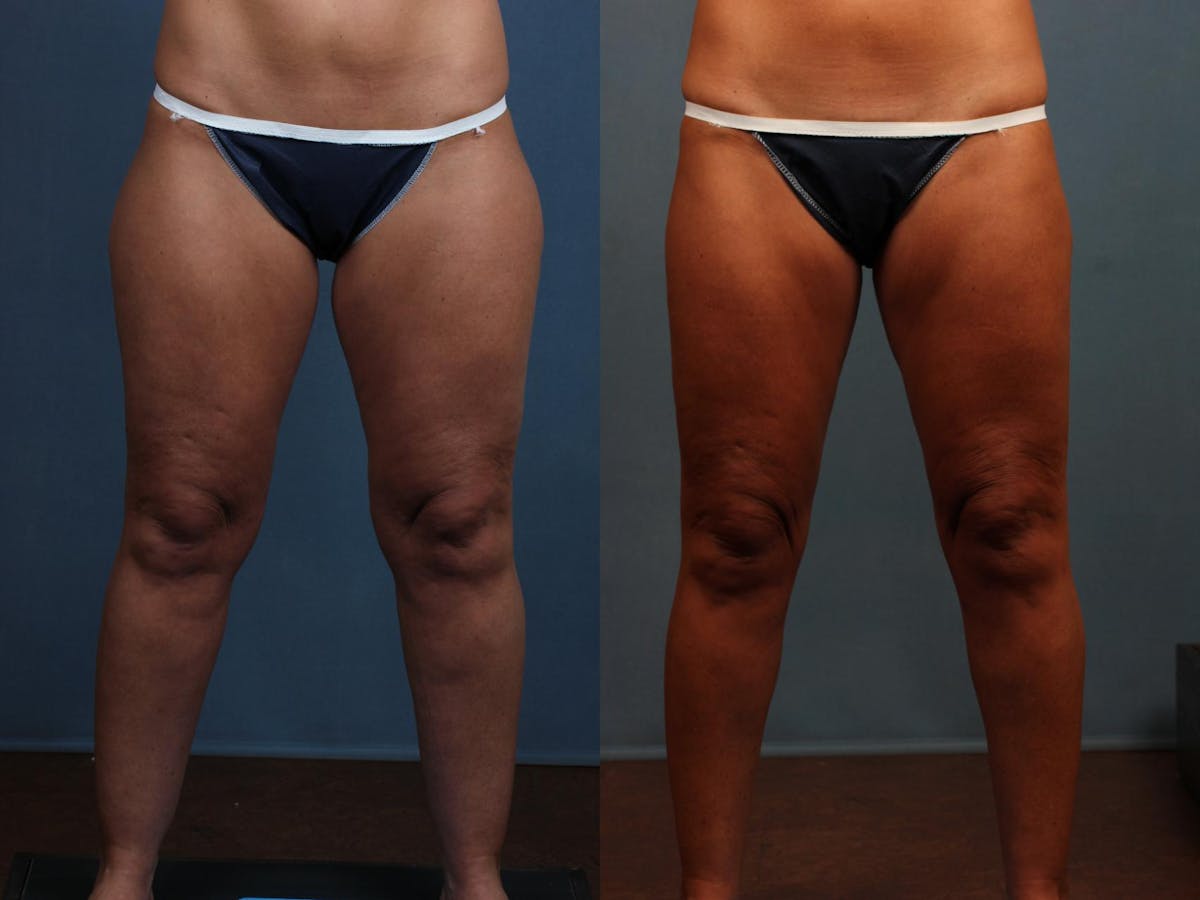 Body/Thigh Lift Before & After Gallery - Patient 304495 - Image 1