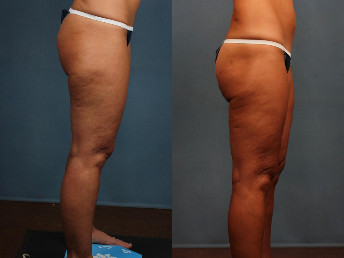Body/Thigh Lift Before & After Gallery - Patient 304495 - Image 3
