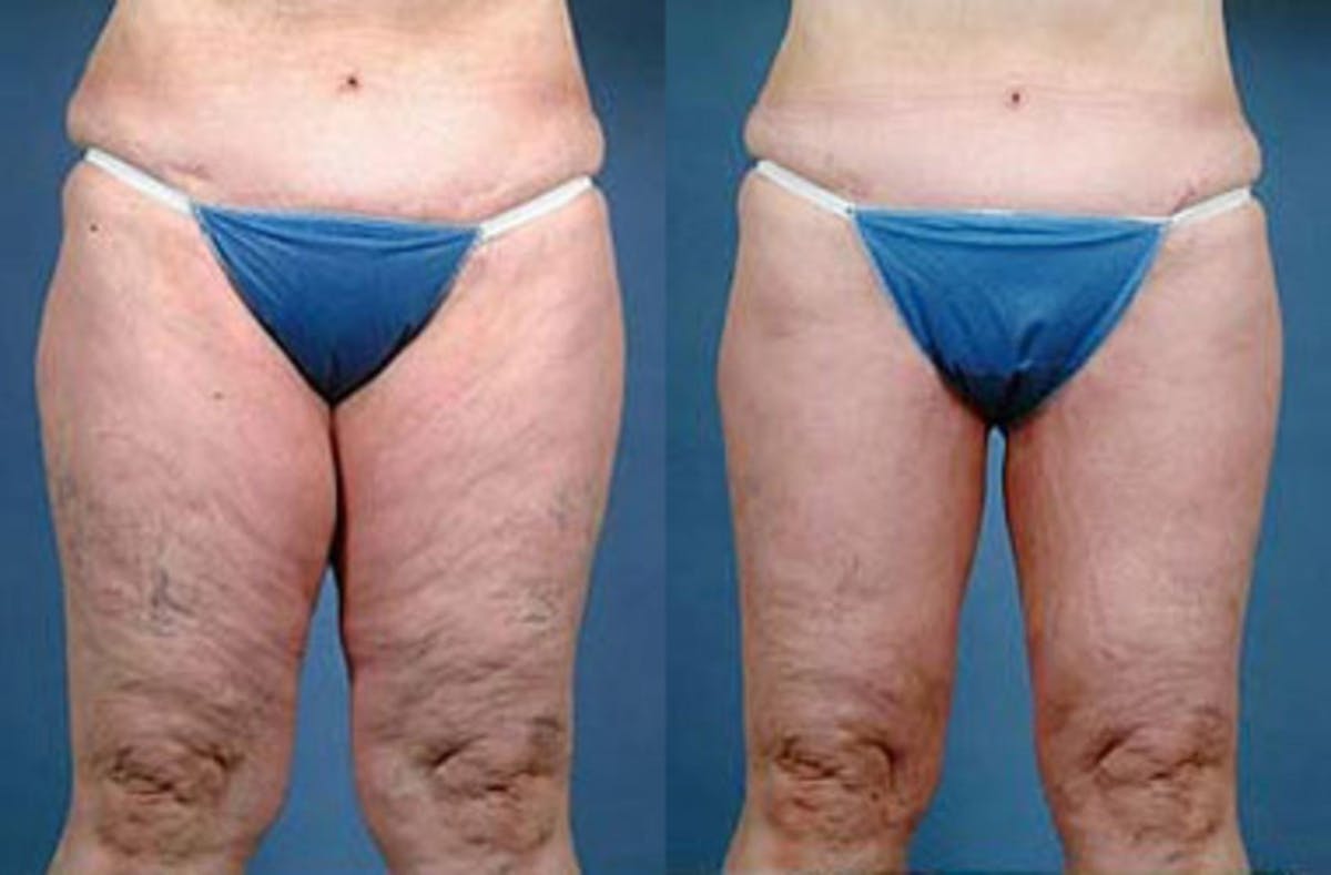 Body/Thigh Lift Before & After Gallery - Patient 143962 - Image 1