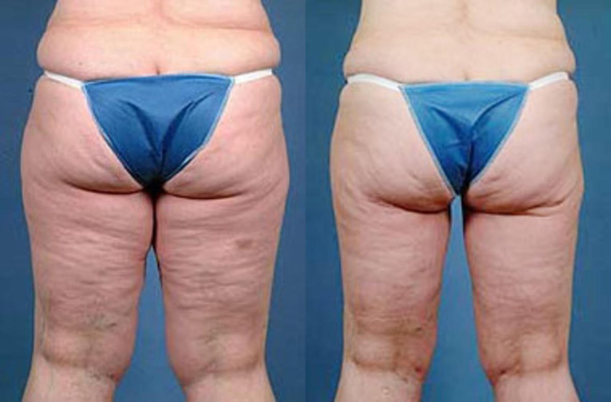 Body/Thigh Lift Before & After Gallery - Patient 143962 - Image 2