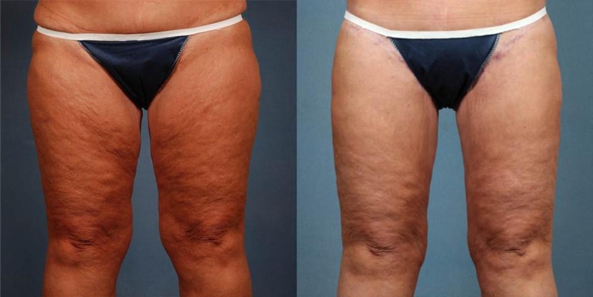 Body/Thigh Lift Before & After Gallery - Patient 638429 - Image 1