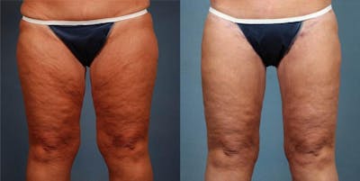 Body/Thigh Lift Before & After Gallery - Patient 638429 - Image 1