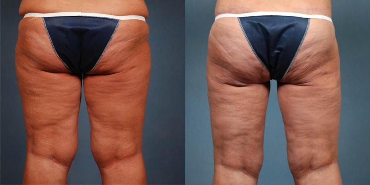 Body/Thigh Lift Before & After Gallery - Patient 638429 - Image 2